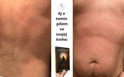 Žihľavka – ako sa z nej uzdraviť?